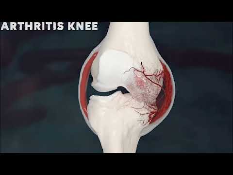 Genicular Artery Embolization (GAE)