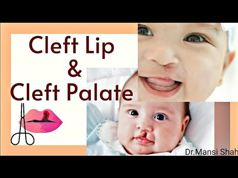 Cleft Lip And Cleft Palate | Opening or Split in Lips and palate