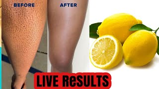 HOW TO GET RID OF STRAWBERRY LEGS IN 7DAYS