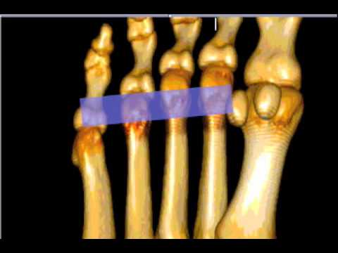 How To: Morton's Neuroma Case Study Video