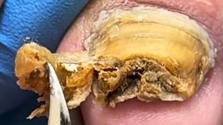 Soak Soft Onychomycosis And Remove A Lot Of Impurities【Xue Yidao】