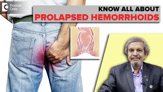 Hemorrhoids|Prolapsed Hemorrhoids|Types of Hemorrhoids & Treatment -Dr.Rajasekar M R|Doctors