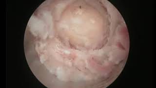 CALCIFIED LUMBAR FACET CYST