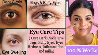 Naturally 💕 Eyes Care Tips || CURE* Puffy Eyes, Eye bags, Dark Circles, Redness & Swelling