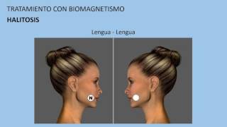 Halitosis  Tratamiento con biomagnetismo #14