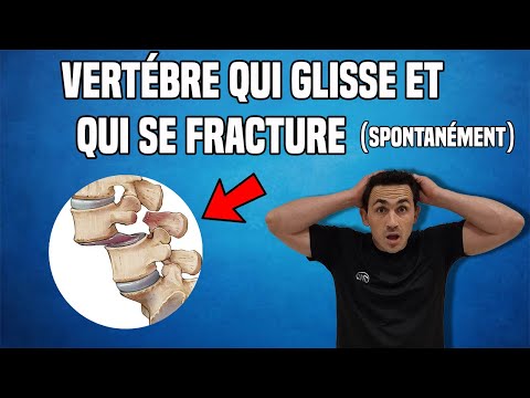 TRAITEMENT DU SPONDYLOLISTHÉSIS LOMBAIRE ...