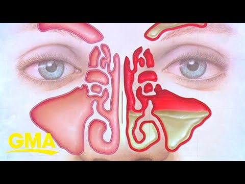 How to treat sinus infection symptoms at home