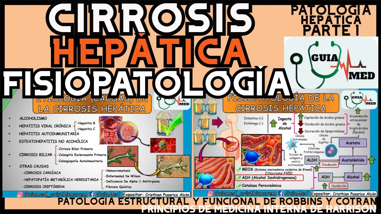 CIRROSIS HEPÁTICA FISIOPATOLOGÍA | GuiaMed