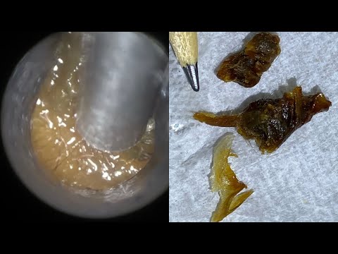 76 - Two Huge Ear Wax Plugs Removed using the WAXscope®️