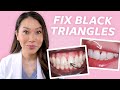 FIX Gaps in Teeth - How to Close Black Triangles