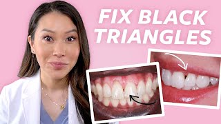 FIX Gaps in Teeth - How to Close Black Triangles