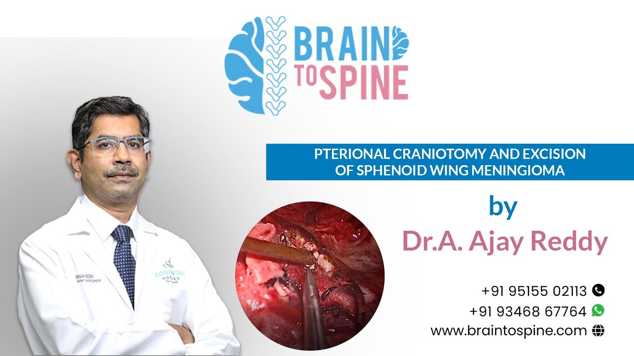 Pterional craniotomy and excision of sphenoid wing meningioma Dr.A.Ajay Reddy