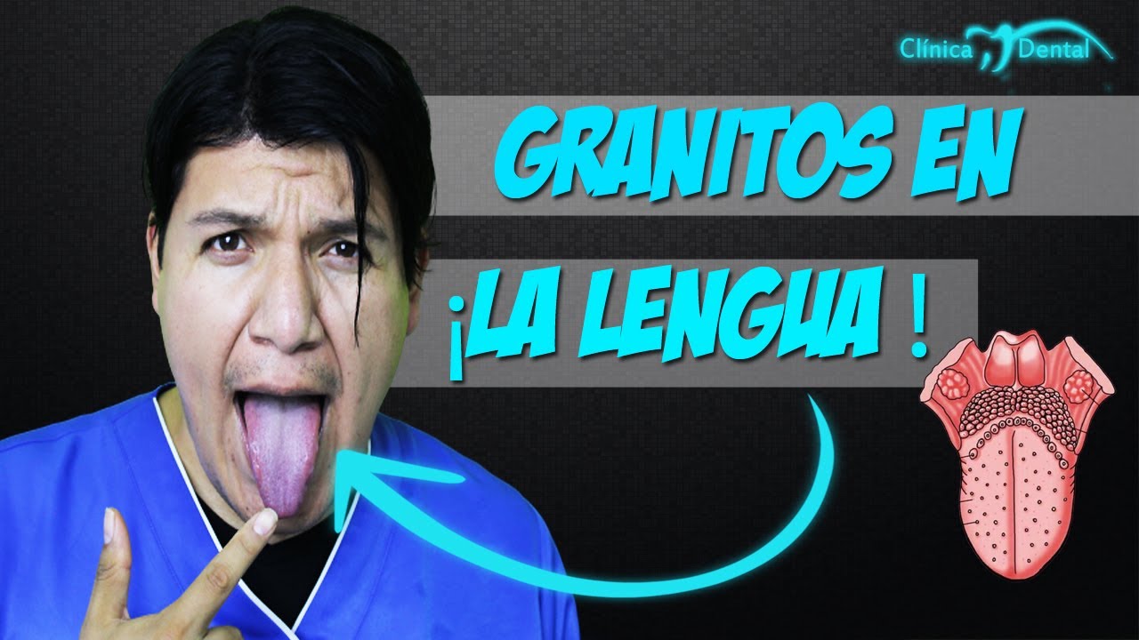 Granitos en la lengua Clinica Dental Velez CDMX