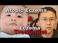 Eczema (Atopic dermatitis) | Eczema treatment & Triggers
