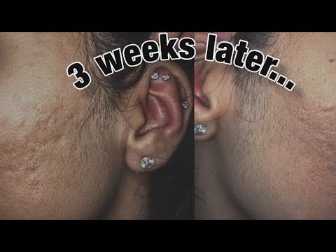 download lagu mp3 mp4 Does Dermaplaning Cause Stubble, download lagu Does Dermaplaning Cause Stubble gratis, unduh video klip Does Dermaplaning Cause Stubble