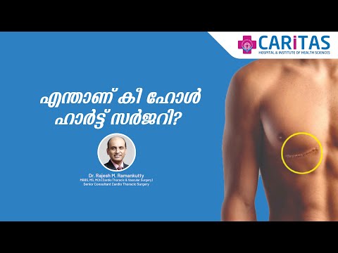 Key Hole Heart Surgery | Dr. Rajesh M. Ramankutty | Caritas Hospital