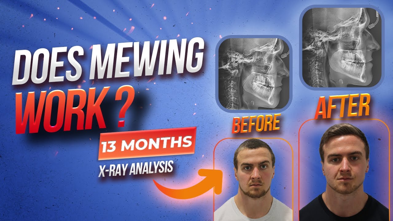 Does Mewing Really Work For Adults? 13 Month Before/After X-Ray Analysis