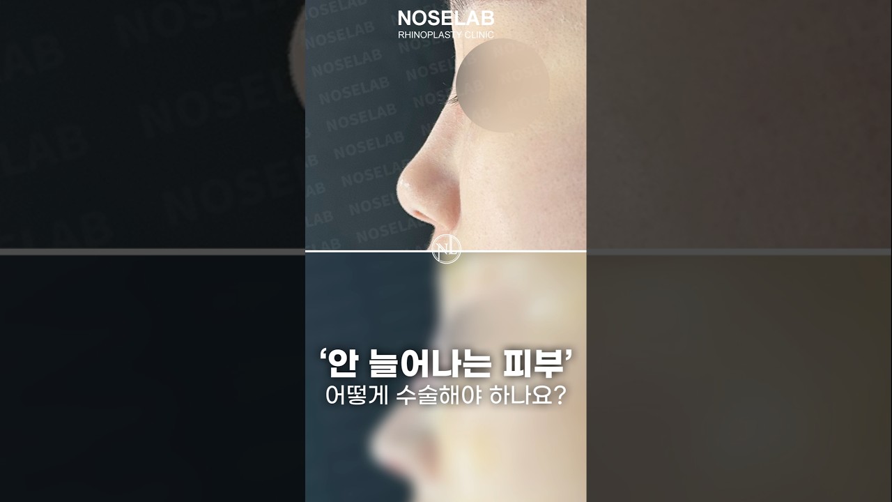 Rhinoplasty transformation after nose filler removal at NoseLab Korea