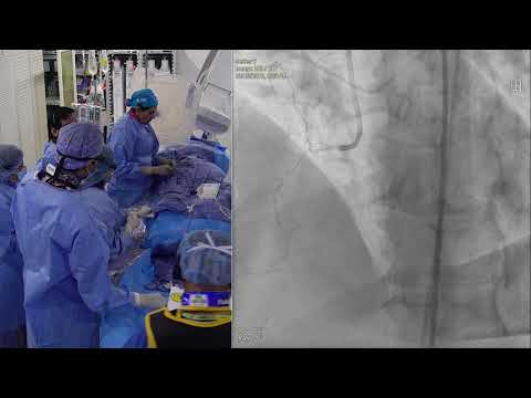 Recanalization of a complex RCA CTO using Antegrade/Retrograde Approach