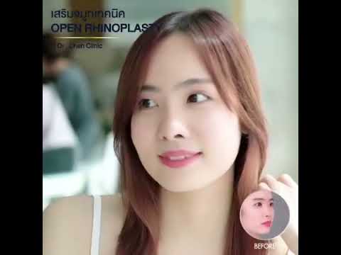 เสริมจมูกครั้งแรก โคเรียมากกกก …