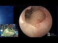 Middle Ear Anatomy & Reconstruction