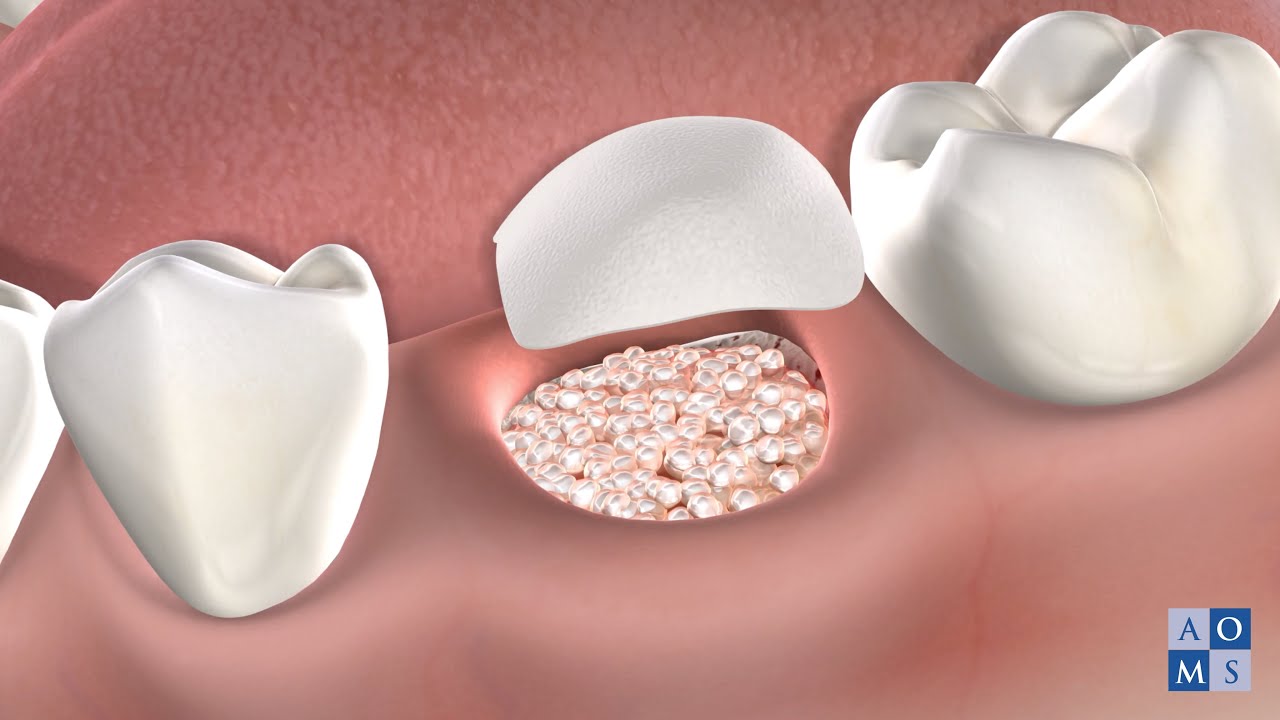 Instrucciones Post-Operatorias: Injerto del Hueso | Amarillo Oral & Maxillofacial Surgery