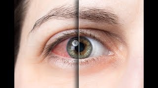 How to Get rid of Red Eyes without Eye Drops