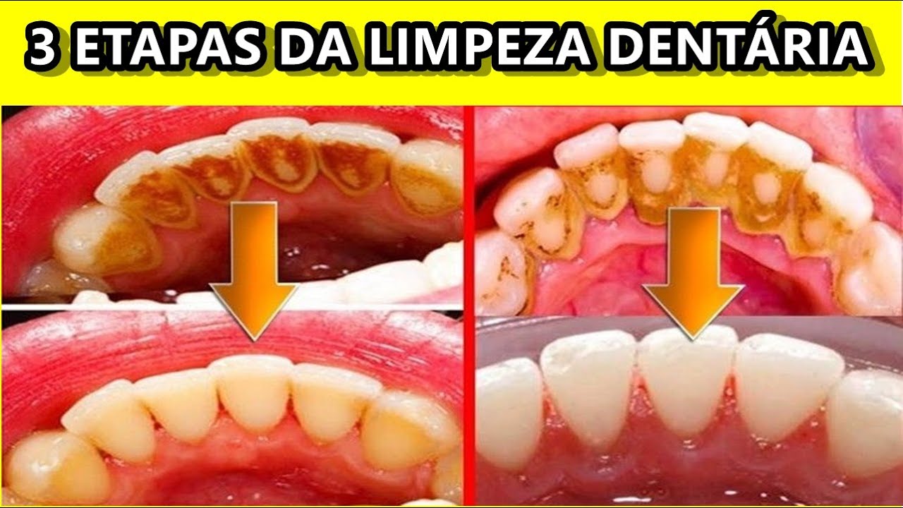 Limpeza Dentária: Como Funciona e quais etapas (resumo).