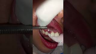 Abscess tooth infection