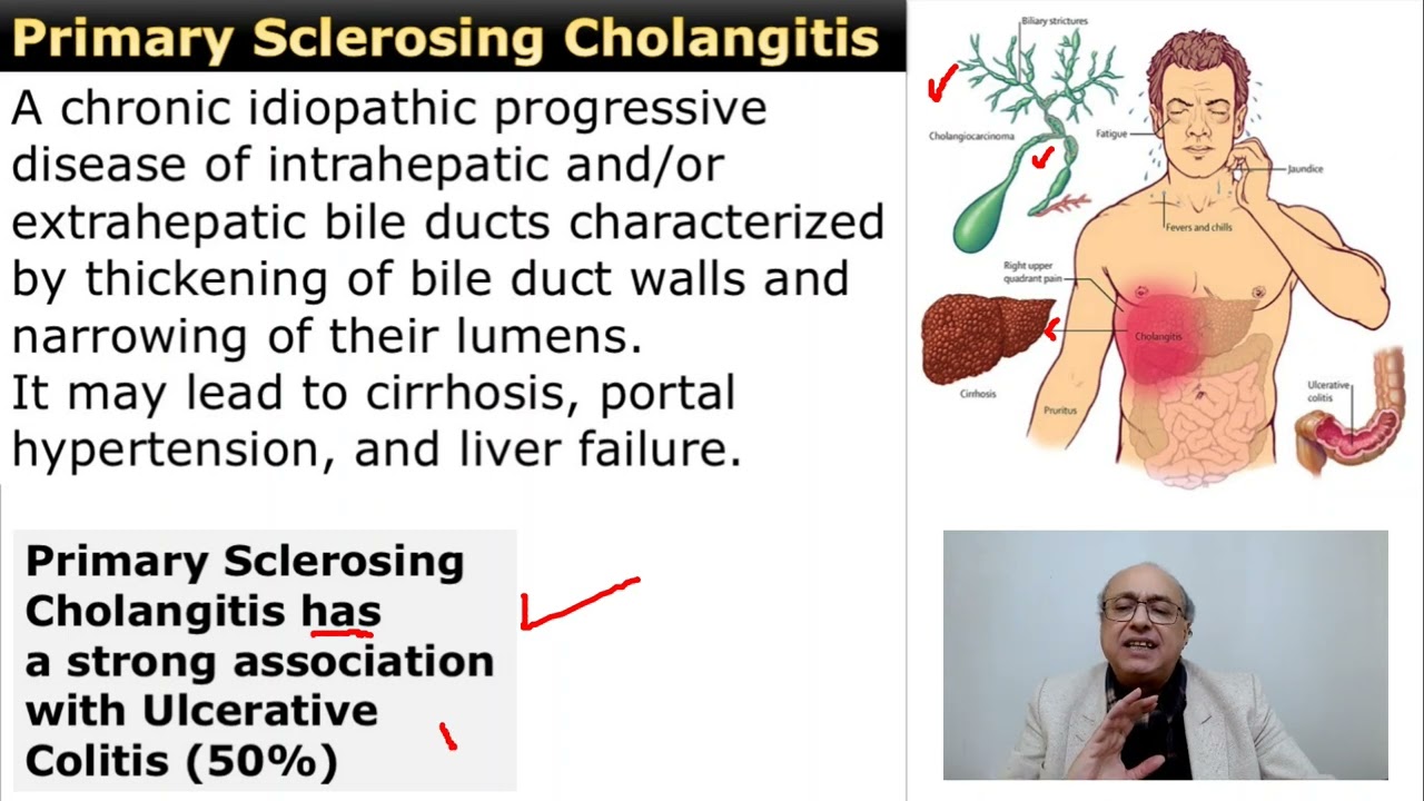 Primary Sclerosing Cholangitis