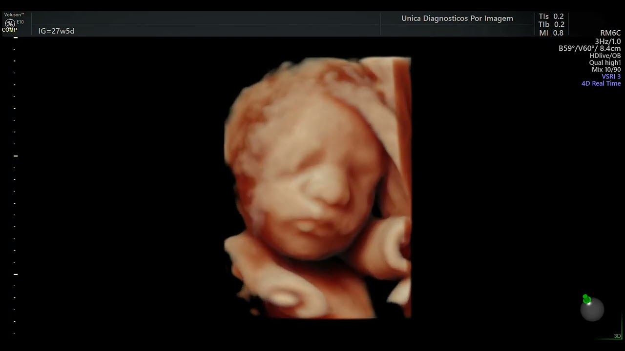 Ultrassom 4D HD Live - (27 semanas de gestação)-02