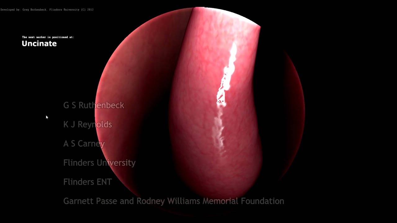 Haptic VR Endoscopic Sinus Examination Simulation - Nasendoscopy Sim