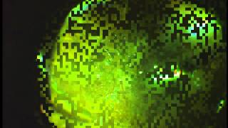 Desprendimiento de retina por necrosis retinal aguda [Dr. Emilio Dodds]