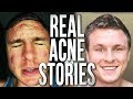 People's Severe Acne Stories | YOU'RE NOT ALONE