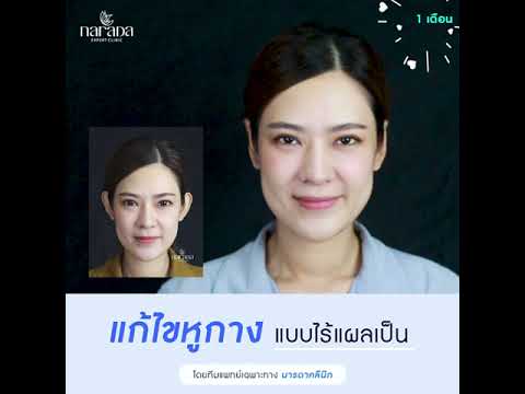 แก้ไขหูกางแบบไร้แผลเป็น ที่ นารดาคลินิก แก้ไขหูกางแบบไร้แผลเป็น ที่ นารดาคลินิก