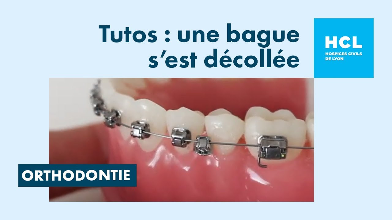 Une bague décollée