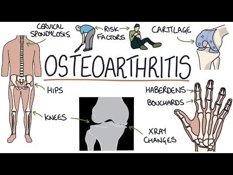 Understanding Osteoarthritis