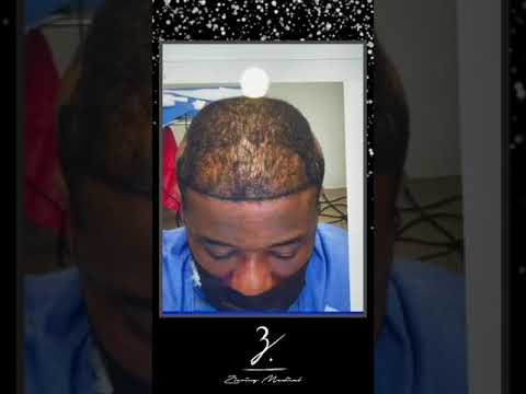 African American FUE Hair Transplant Results | 💫