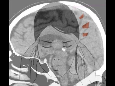 Astra Zeneca's VITT and 2 other life threatening headaches you just can't miss.