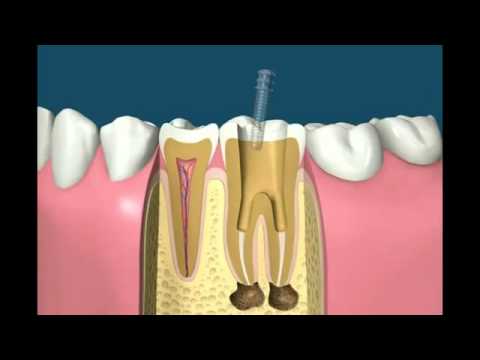 Teeth Whitening Patient — ADS Dental Hyderabad