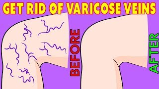 How to get rid of Varicose Veins naturally in 3 minutes a day!