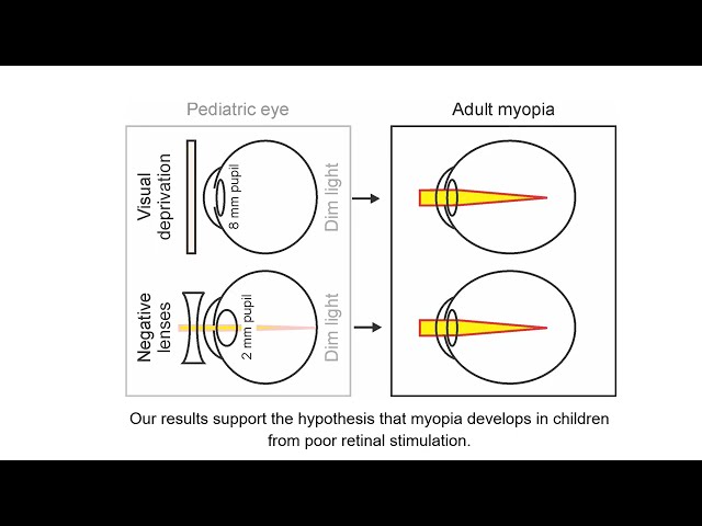 Accommodative visuomotor function driven by contrast through ON/OFF pathways & enhanced in myopia
