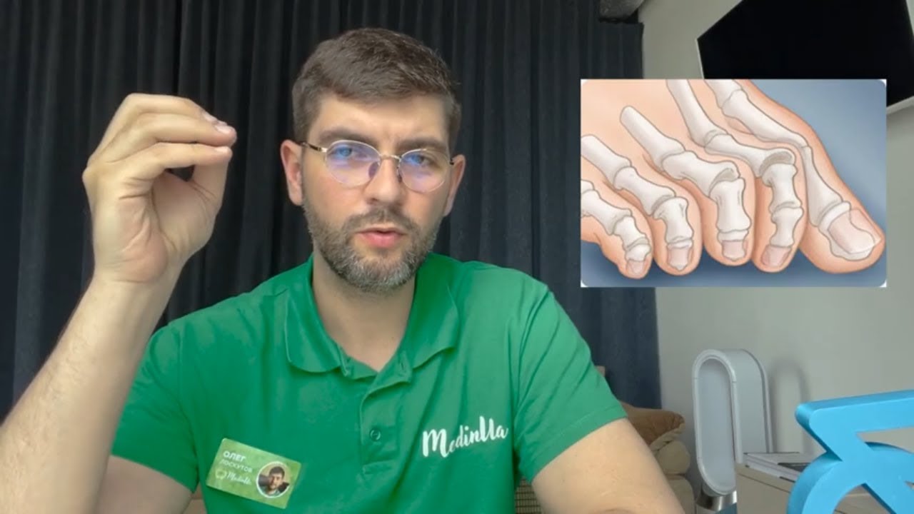Болят пальцы на стопе! Деформация пальцев стопы. Причины появления, лечение.