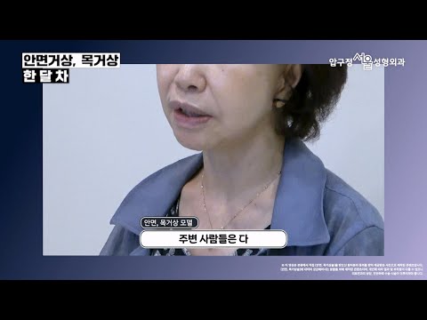  #안면목거상술 처진 팔자주름, 목주름 한달차