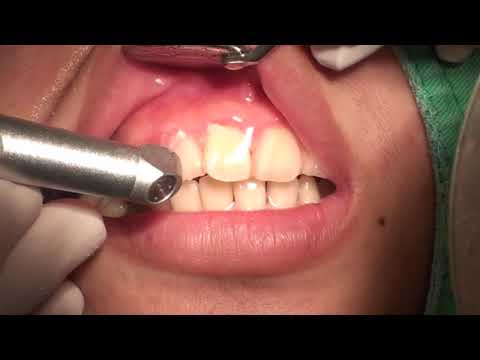Gingivitis Treatment with LIGHTMED's SAPPHIRE Laser