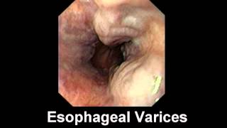 Hepatitis C Crónica