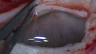 Traumatic cyclodialysis cleft repair - direct cyclopexy