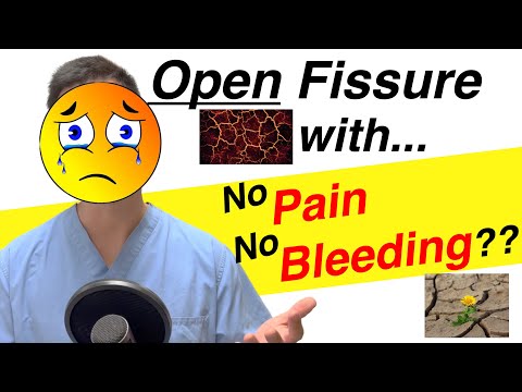 No pain or bleeding...is the ANAL FISSURE still there?