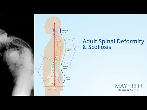 Adult Spinal Deformity and Scoliosis