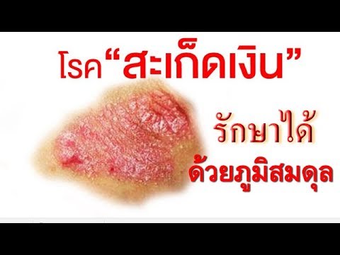 เริ่มมีอาการกลาก ครีมรัสเซียสำหรับรายชื่อโรคสะเก็ดเงิน